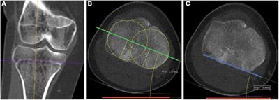 A new method for assessing tibial torsion using computerized tomography in a pediatric population